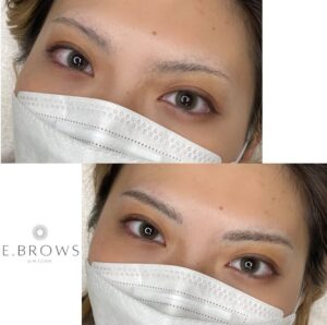 メディカルブロー症例